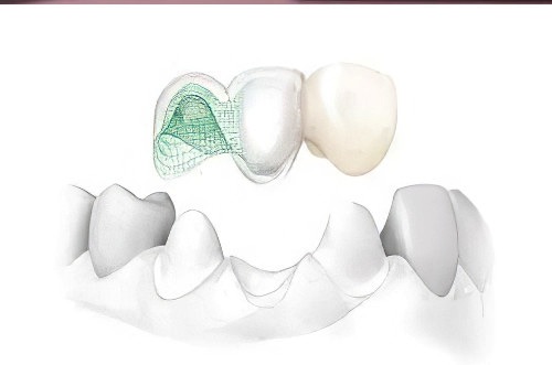 soins dentaires Soumoulou Prothèse sans métal